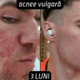 Rezultate 3 luni tretinoina acnee vulgara