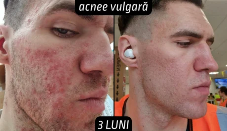 Rezultate 3 luni tretinoina acnee vulgara