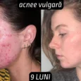 Rezultate acnee vulgara femei 9 luni