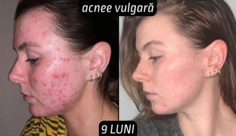 Rezultate acnee vulgara femei 9 luni