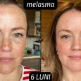 Rezultate tretinoina melasma 6 luni
