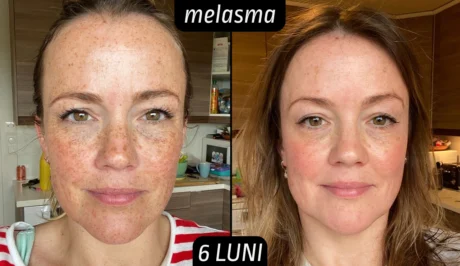 Rezultate tretinoina melasma 6 luni