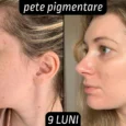 Rezultate tretinoina pete pigmentare 9 luni