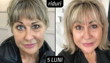 Rezultate tretinoina riduri 6 luni