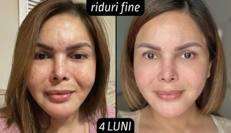 Rezultate tretinoina riduri fine 4 luni