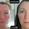 Rezultate tretinoina rozacee 2 luni