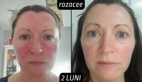 Rezultate tretinoina rozacee 2 luni